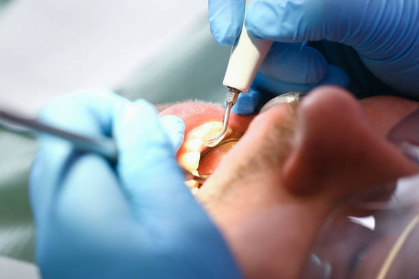 Best Emergency Wisdom Teeth Removal in West Monroe, LA